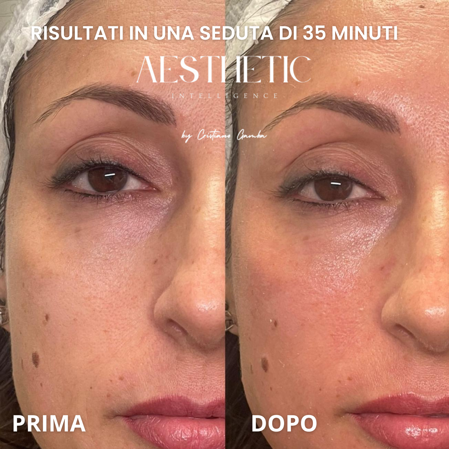 Summer Shield™ – Protocollo Viso PRE-SUN con Tecnologia T-Shape